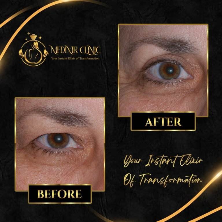 blepharoplasty 1