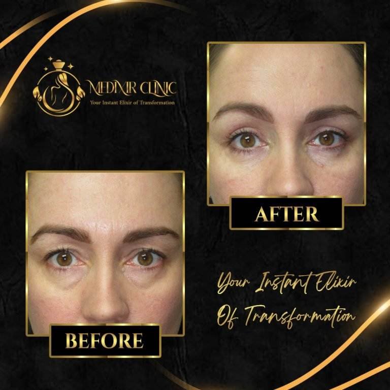 blepharoplasty 2