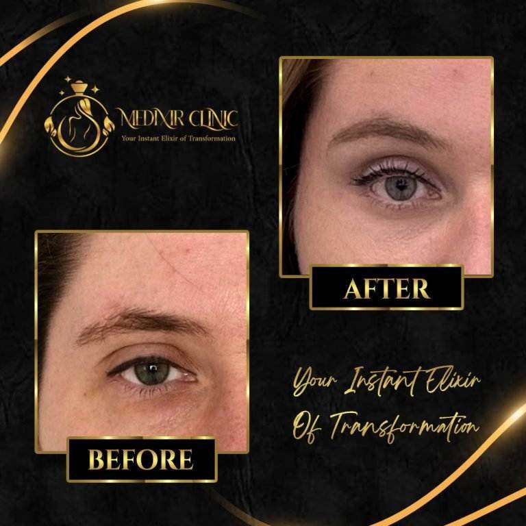 blepharoplasty 3