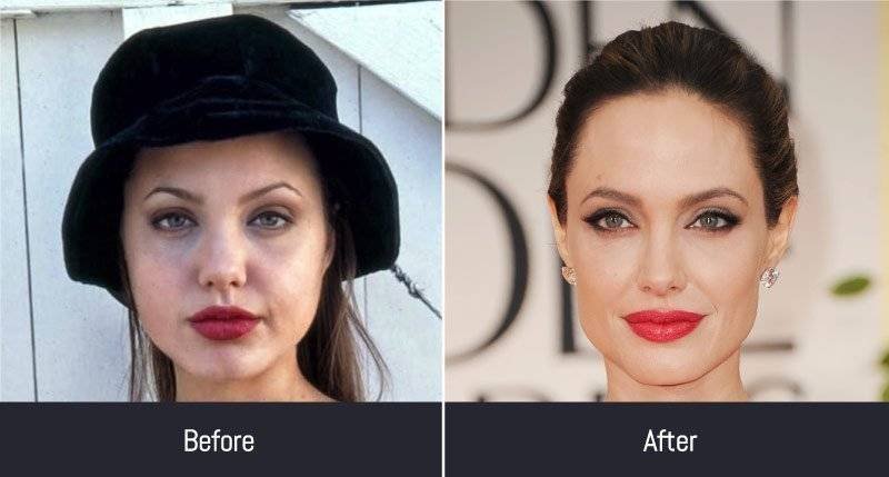 Angelina Jolie Facelift