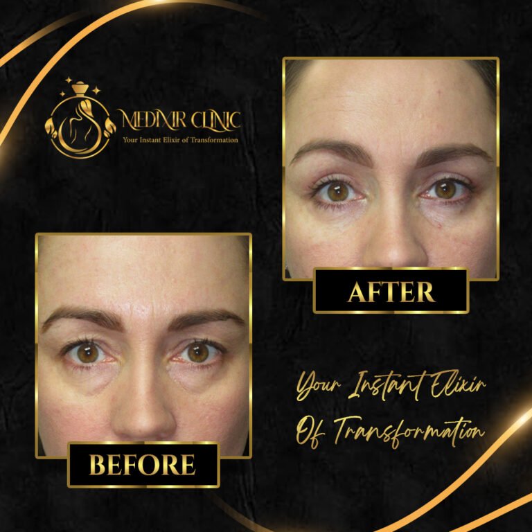 blepharoplasty 2