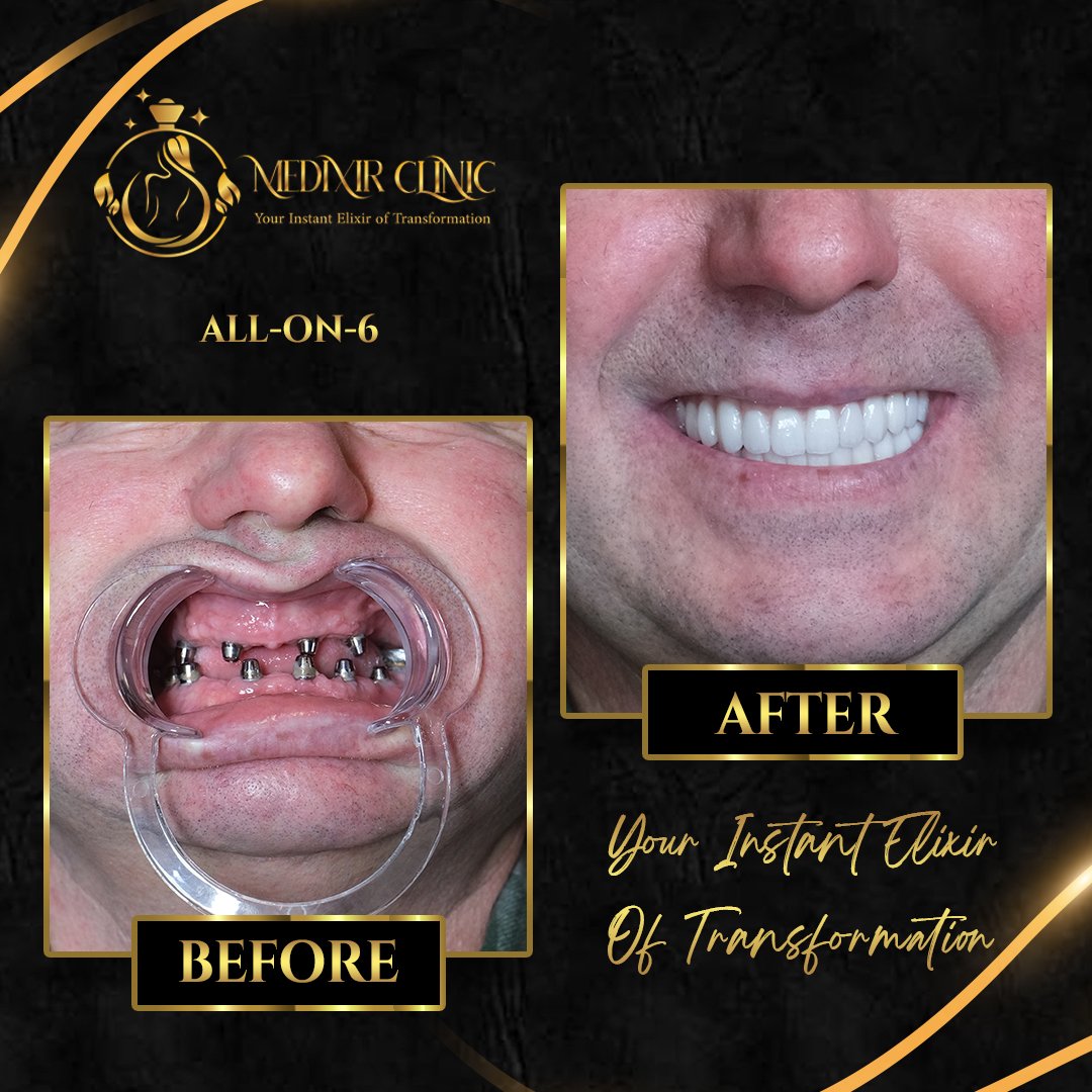 Before After 8