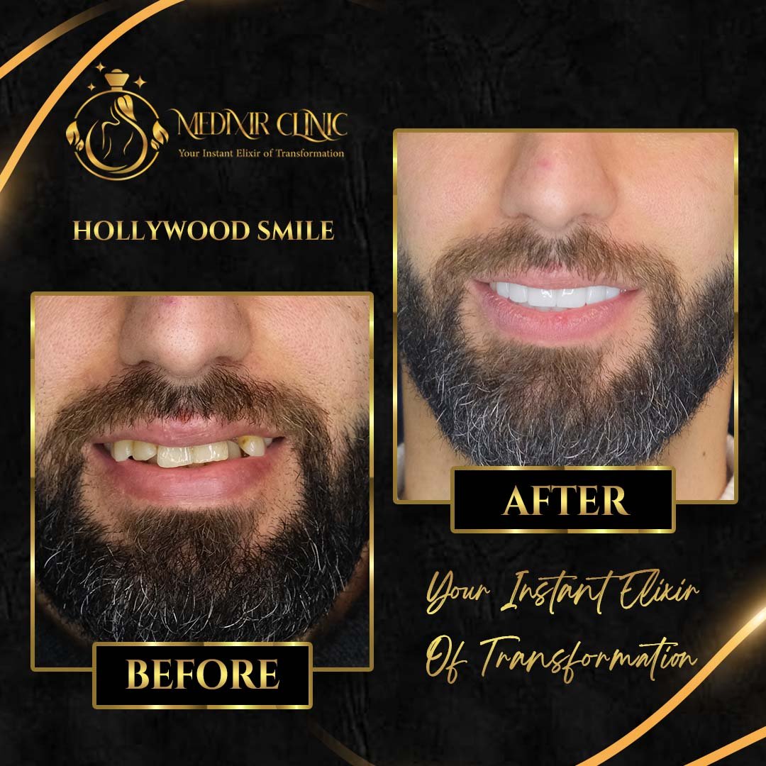 Before After 3