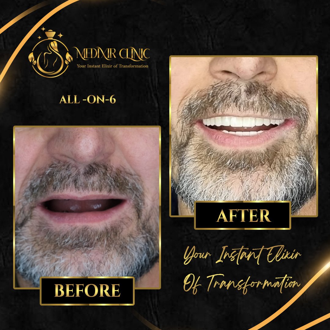 Before After 1
