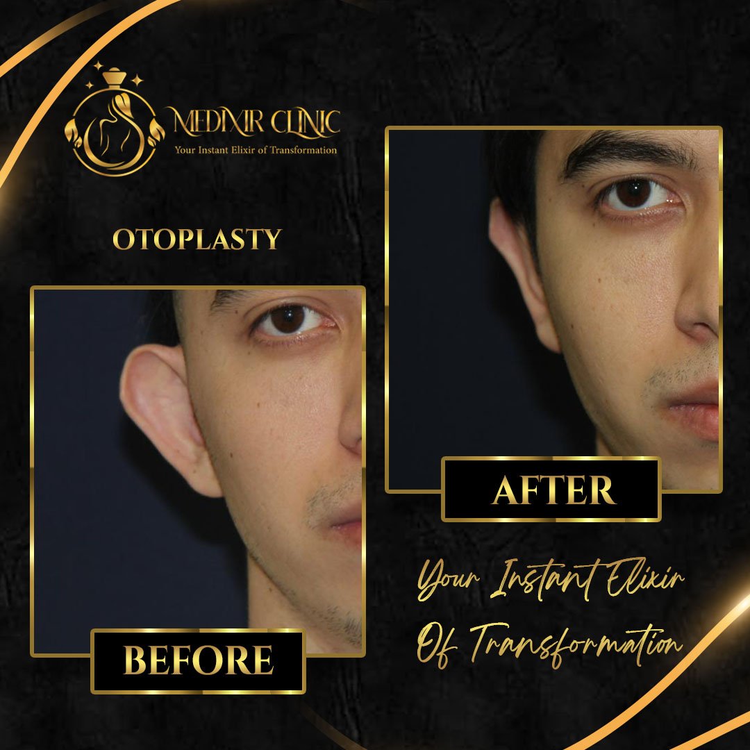 Before After 4