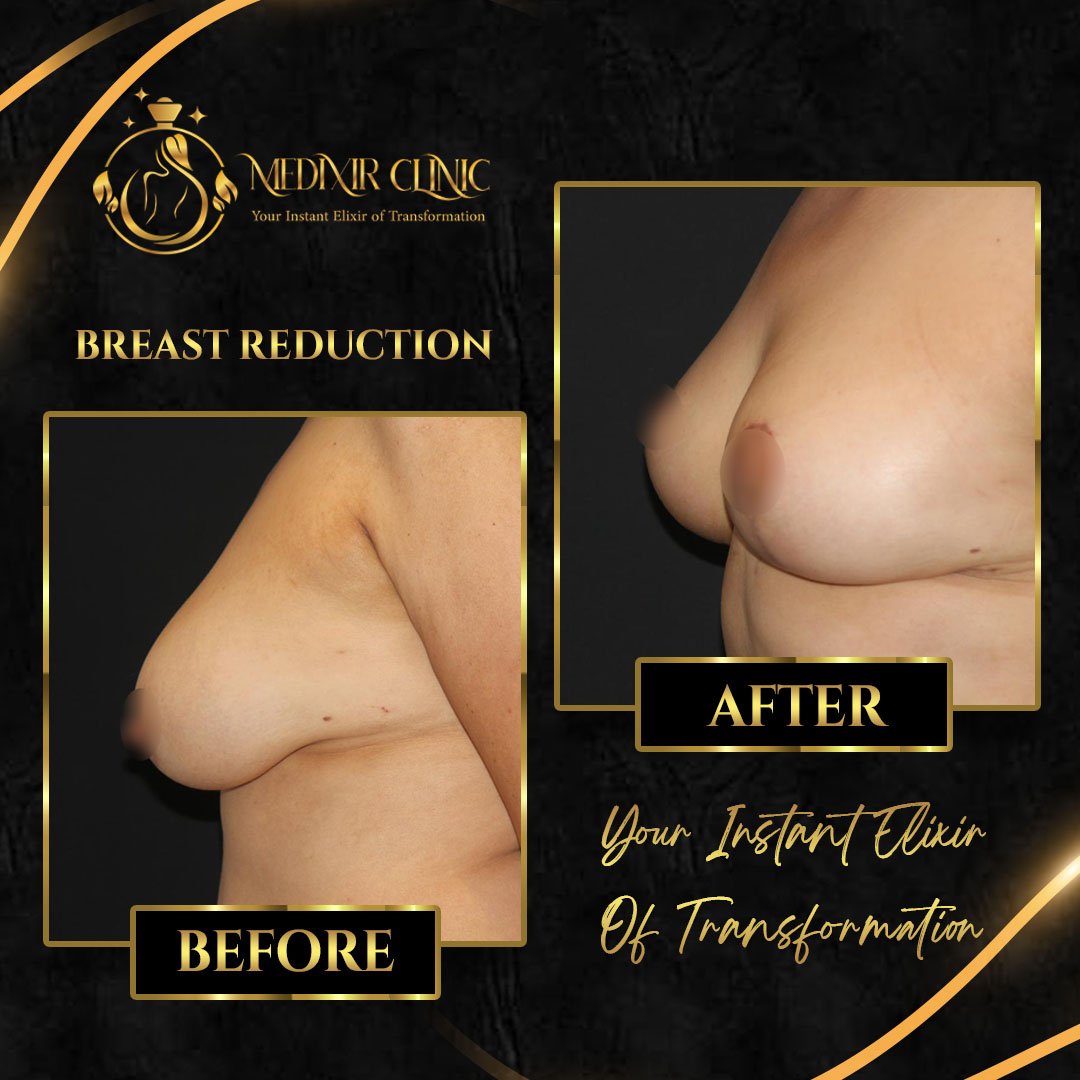 Before After 5