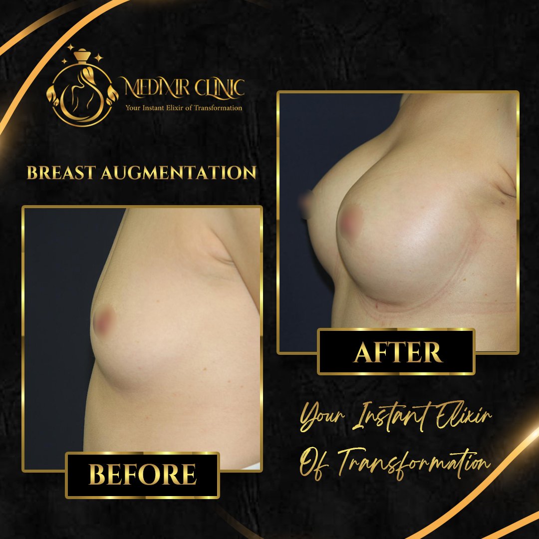 Before After 8